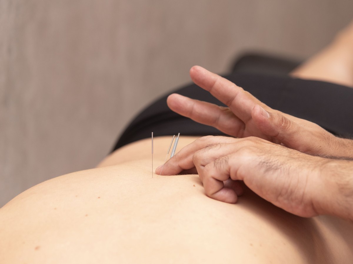 Agulhas de acupuntura posicionadas na região dorsal